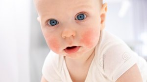 Trockene Haut bei Babys und Kindern: Hautärzte sagen, was wirklich hilft